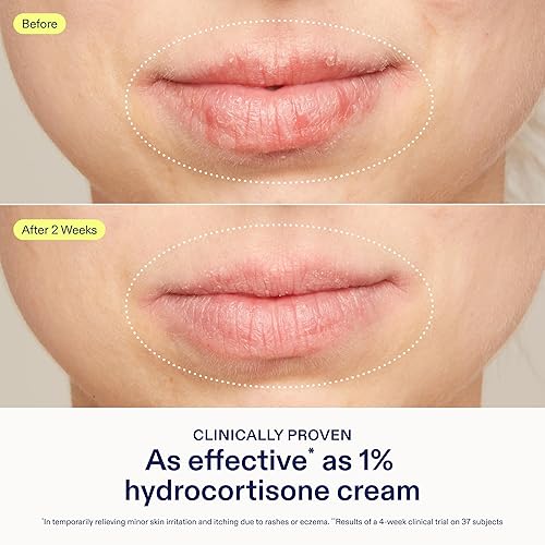 Miniatura 4 de Skinfix Bálsamo para aliviar la dermatitis, 1.7 onzas líquidas, probado como hidrocortisona al 1%, alivia el eccema y la picazón, aceptado por la