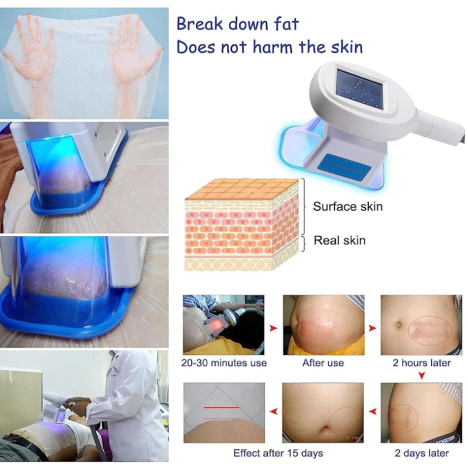 BCBKD Fett Einfrieren Kryolipolyse Professionelle Abnehmen Maschine Körper-Kryolipolyse-Vakuum Mit 3 Griffen Für Gewichtsverlust, Fett Abbau, Cellulite Verringern,Körperformung