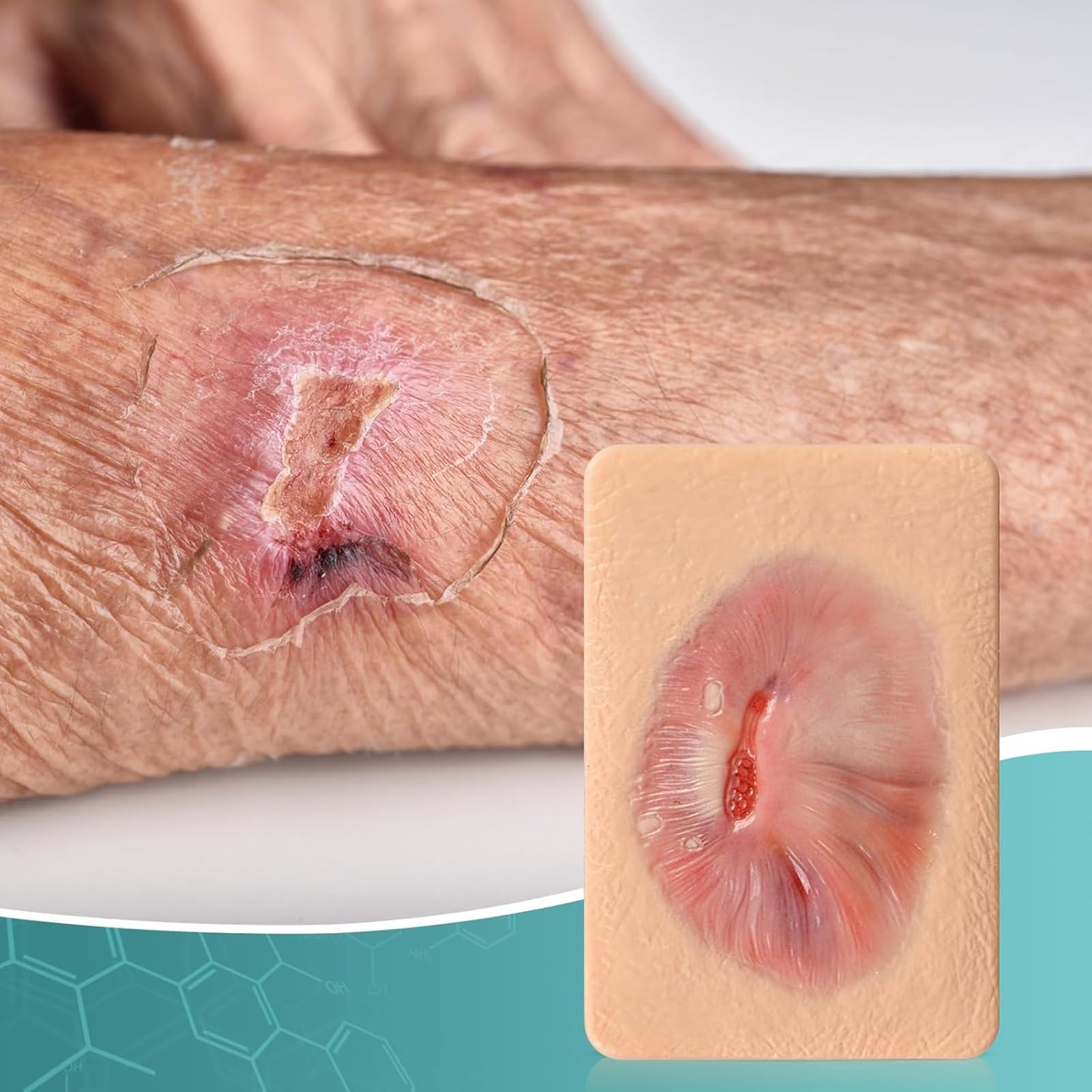 Dispositif De Simulation De Pansement par Granulation (3 Ou 4 Pièces), Modèle De Pansement De La Taille d'une Paume, pour La Formation Médicale Et Les Démonstrations De Soins des Plaies