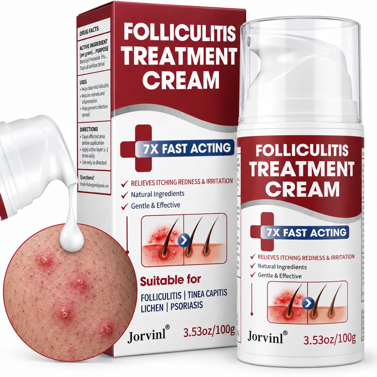 Folliculitis Cream with 5% Benzoyl Peroxide, 3.53 Fl Oz