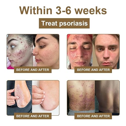 Miniatura 2 de Spray de tratamiento de veneno de abeja elimina manchas para hombres y mujeres, aerosol de decoloración de veneno de abeja, aerosol para la piel de