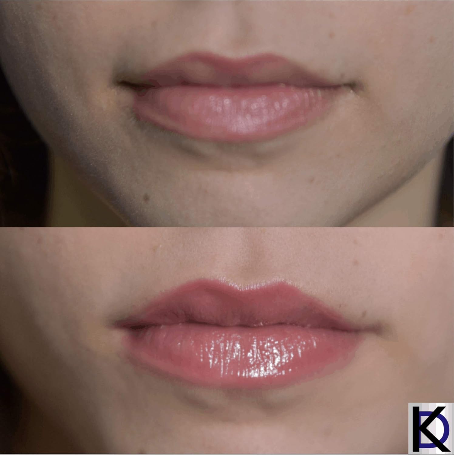 KD High Volume Lip Plumping Amplifier