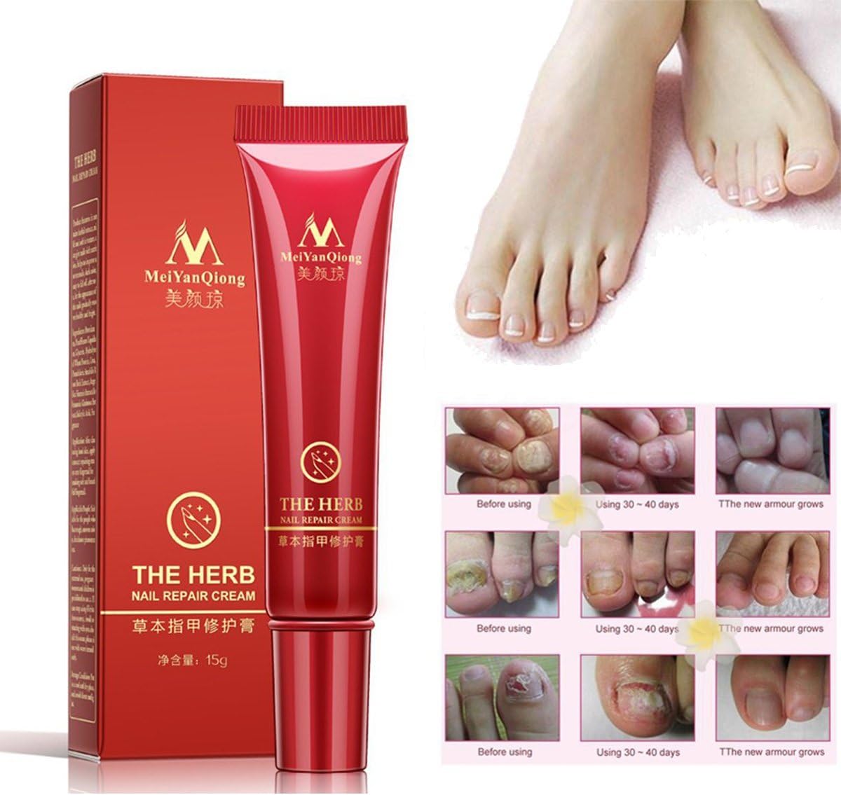 RWM - Foot Nail Cream, Protector Skin Care Cream Nail Fungus Treatment Herb Anti Fungal Nail Repair Cream 15g