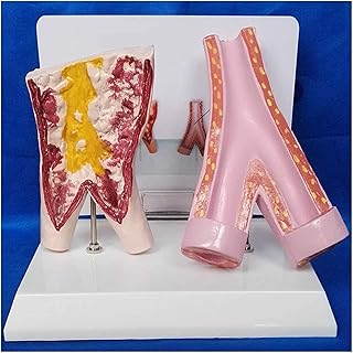 Study Model Blood Vessels Model - Human Organ Anatomy Model - Comparison Model Between Smoking Blood Vessels and Normal Blood Vessels - for Study Display Medical Teaching Model SaiFei