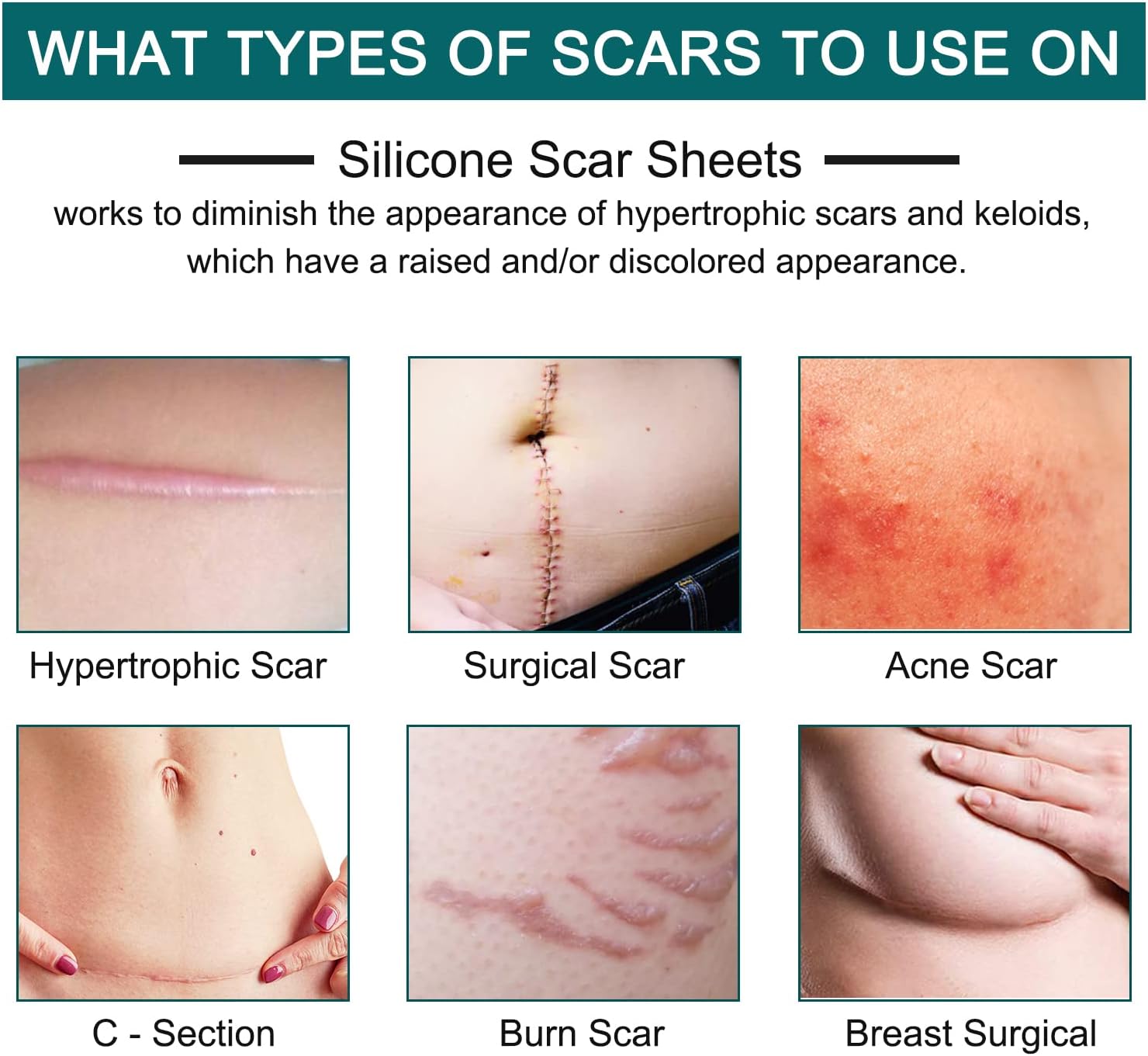 Feuilles de cicatrices en silicone – Rouleau adhésif professionnel réutilisable pour amélioration de cicatrices chirurgicales et césariennes (4,1 x 300,5 cm) - Image secondaire