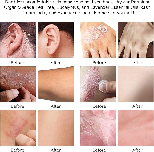 Miniatura 6 de Crema de bálsamo de aceite de árbol de té para dibujo, eczema de irritación relajante, psoriasis, picaduras de insectos, foliculitis, acné, picazón,
