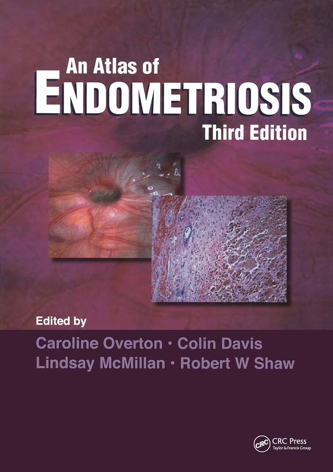 Atlas of Endometriosis (Encyclopedia of Visual Medicine Series)      3rd Edition, Kindle Edition