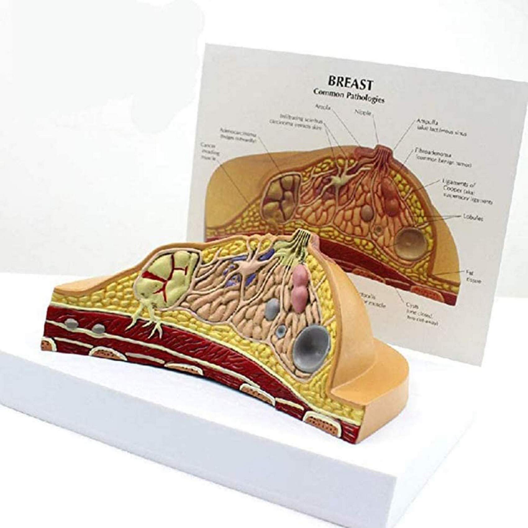 Teaching Model Breast Pathology Model—This Model Demonstrates Breast Pathology Such As Breast Lobules, Invasive Breast Duct Disease, Breast Cysts, and Fibrous Glands