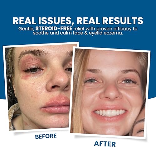 Miniatura 4 de Grahams Natural Kit de alivio del eccema facial y de párpados, tratamiento para piel seca, eczema, dermatitis pereriana y seborreica  Alivio de