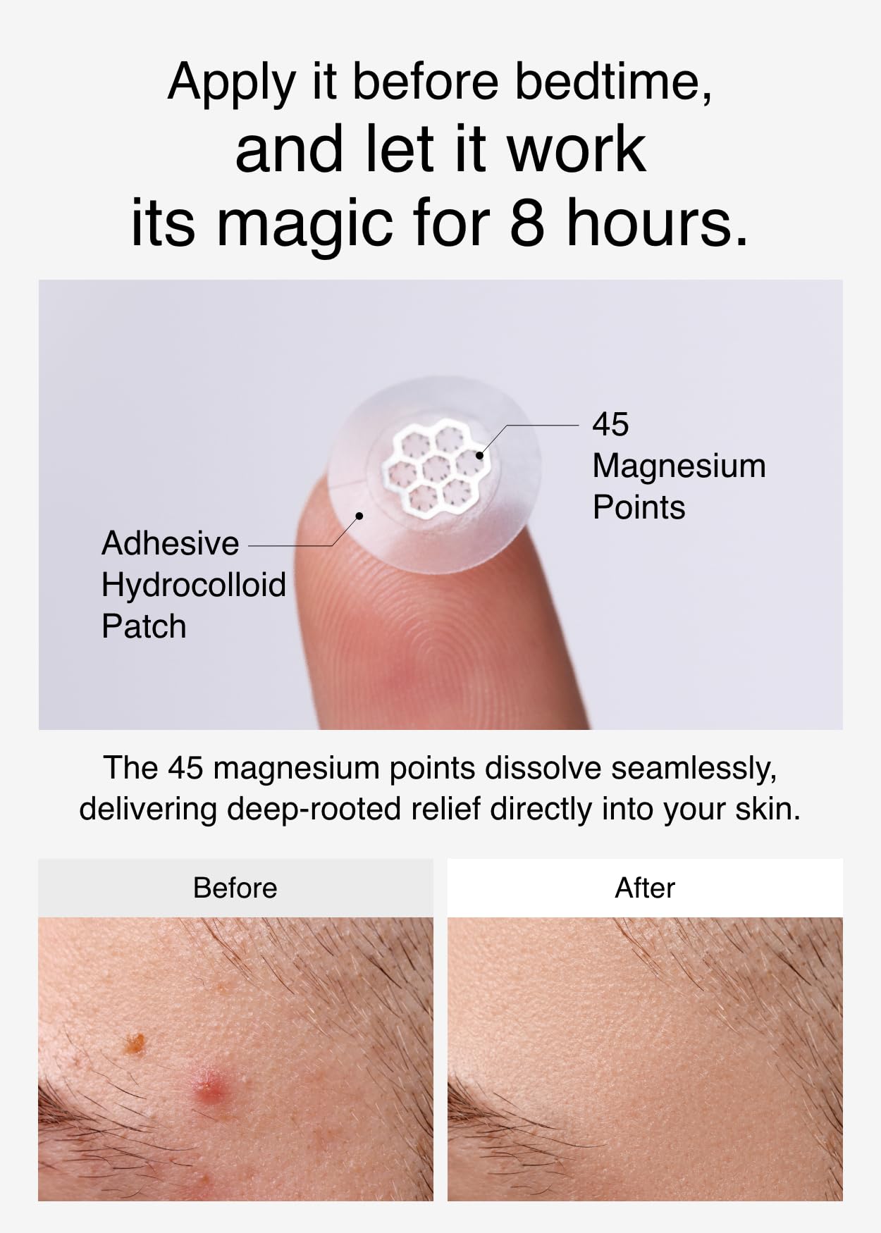 EasyDerm Quick Calming Magnezowe plastry – hydrokoloidowe leczenie trądziku zawiera pęsetę i ampułkę, 10 plastrów, naklejkę na pryszcze, wyprodukowane przez Daewoong Pharmaceutical