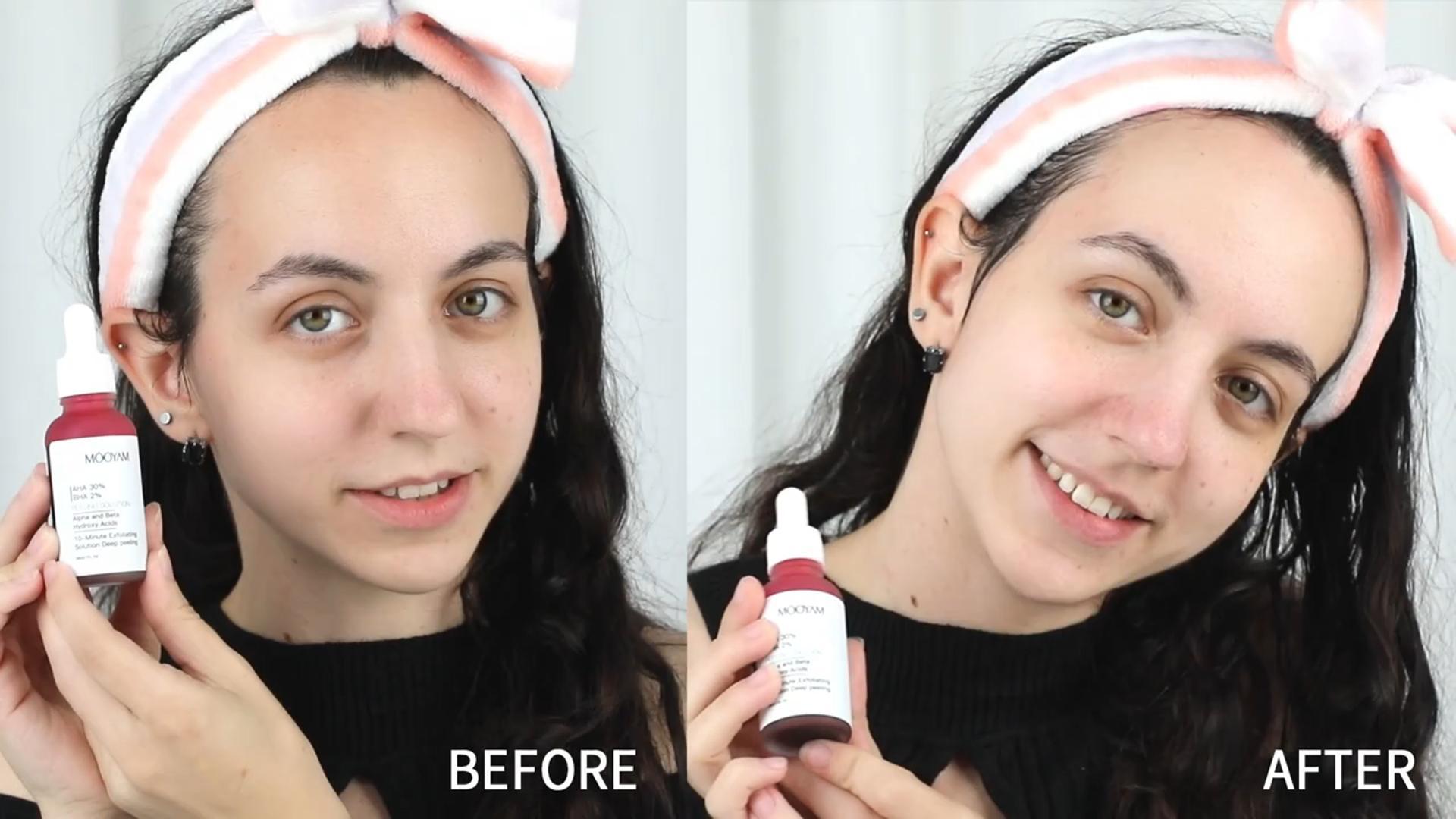 Amazon.com: AHA 30% + BHA 2% Peeling Solution, Chemical Peel for