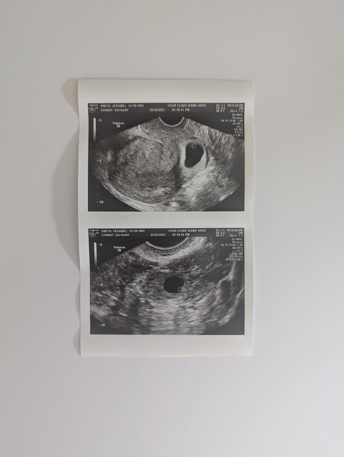 Prank 2D Customized Fake Ultrasound Two Photos Connected B&W