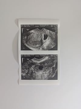 Prank 2D Customized Fake Ultrasound Two Photos Connected B&W