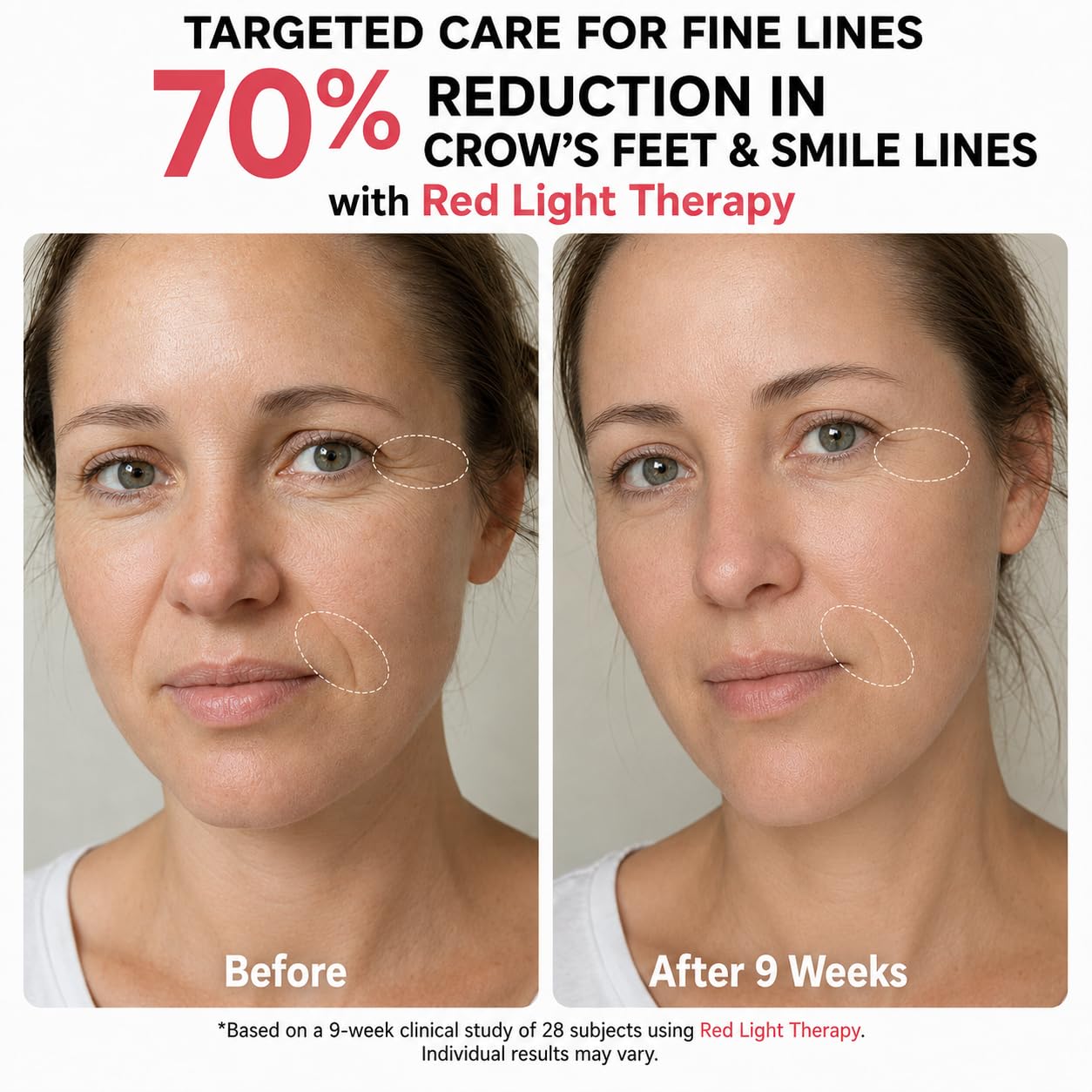 Red Light Therapy for Face, FDA-Cleared Blue Light Mask for Acne