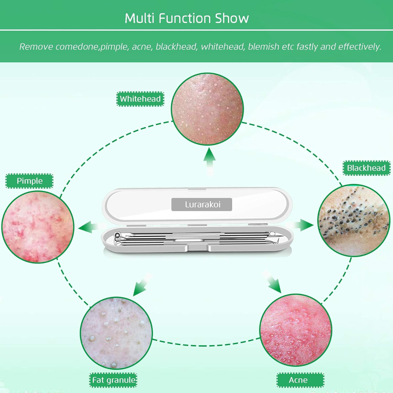 5PCS Blackhead Remover, Pimple Removal Tools, Blemish Whitehead Popping Removal, Whiteheads Spot Removing Zit Tool, Curved Blackhead Tweezers Kit, Treatment for for Risk Free Nose Face Skin : Beauty & Personal Care