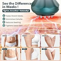 Vista 6 de Masajeador de drenaje linfático, masajeador anticelulítico para celulitis corporal y reducción de estrías de muslos y vientres, herramientas