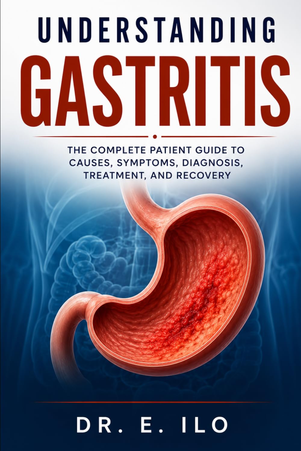 UNDERSTANDING GASTRITIS: The Complete Patient Guide to Causes, Symptoms, Diagnosis, Treatment, Prevention and Recovery (Understanding Digestive Health Series - Doctors guide.)
