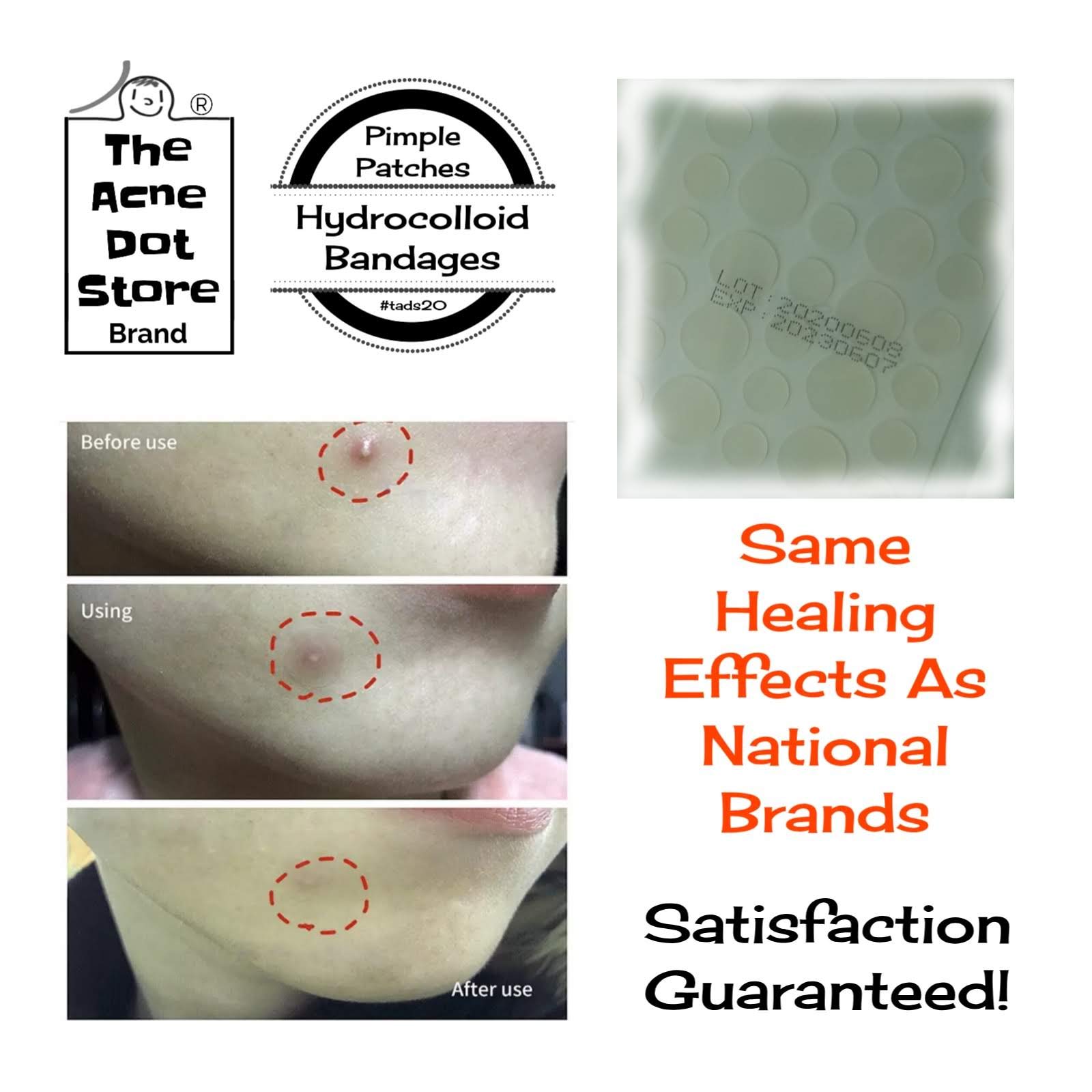 Buy 5pk [75] Acne Dots, Pimple Patches, [SMALL/LARGE SIZE] Cystic Acne Patch, FACE Spot Dots