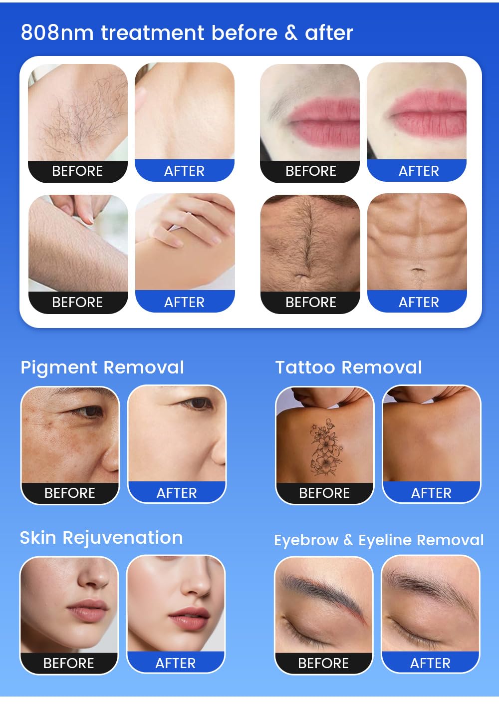 Máquina de depilación multifuncional 4 en 1: depilación corporal completa sin dolor, radiofrecuencia IPL, regeneración de la piel, tratamiento del acné y eliminación de manchas.