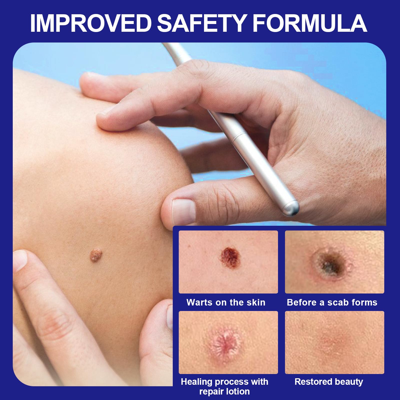 30ml Skin Tag Remover, Suavemente Las Verrugas Quitar Comunes, Mayoría de las Partes del Cuerpo, Fácil de Usar, Fórmula Suave
