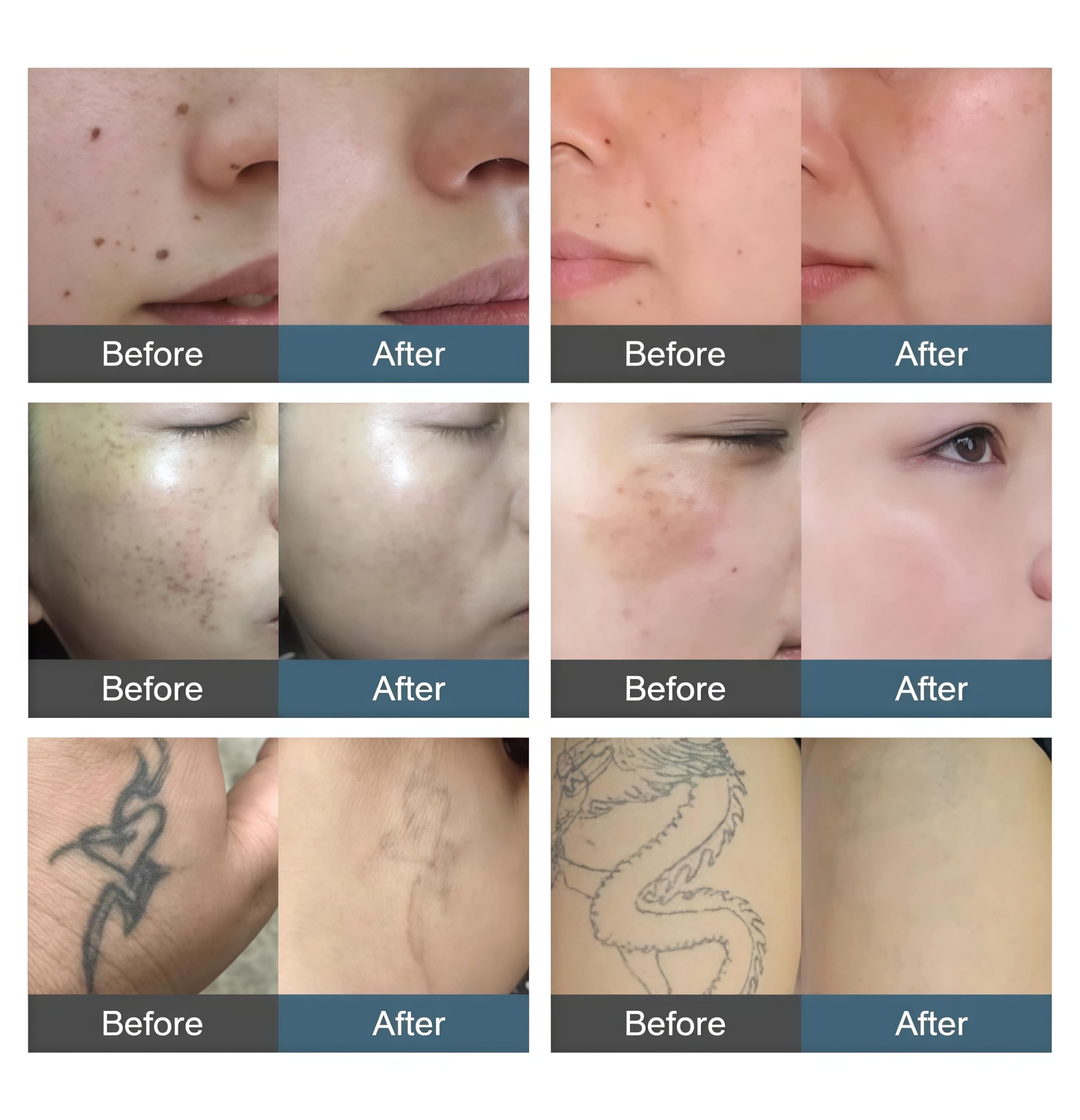 4000W High-Power 2-in-1 Picosecond Laser Hair & Tattoo Removal 755/808/940/1064nm Diodo – Soluzioni di bellezza permanente
