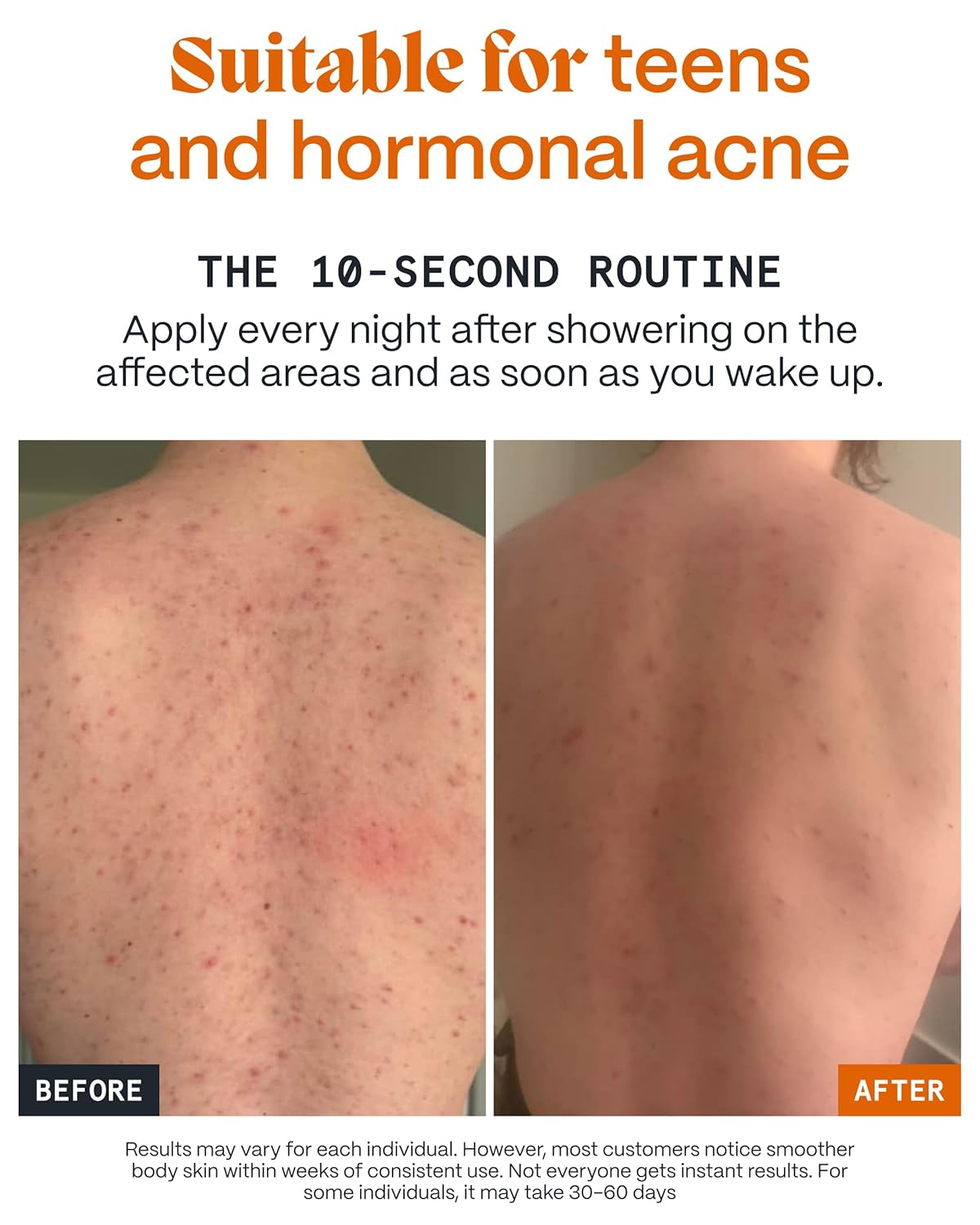 Norse Organics | Body Balm For Acne Prone Skin | Arctic Herbs & Beeswax for Back Chest Shoulders | Thistle Rosehip Marigold Sea Buckthorn | Natural Formula for All Skin Types | 1.7 oz - Image 5