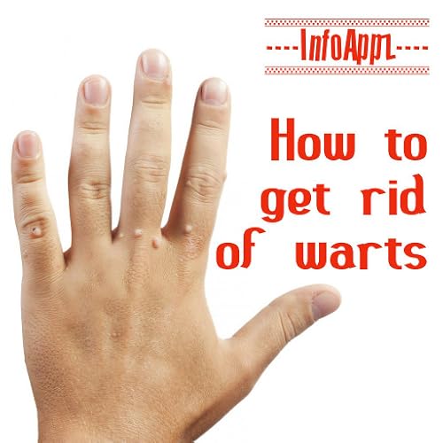How to Get Rid of Warts