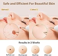 Vista 3 de Nodhaul Effective Maximum Strength WART Remover,Mole and Wart Removal Pen,Dark Spot Removal for Face and Body