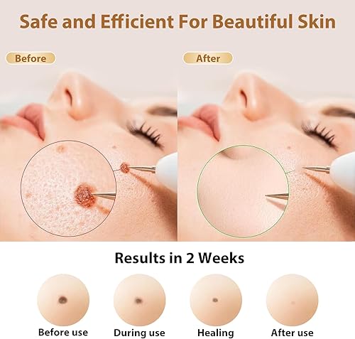 Miniatura 3 de Nodhaul Effective Maximum Strength WART Remover,Mole and Wart Removal Pen,Dark Spot Removal for Face and Body