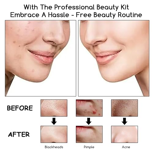 Miniatura 8 de 8 piezas de agujas de acné de acero inoxidable para eliminar puntos negros, pinzas de limpieza de acné, kit de herramientas para reventar espinillas