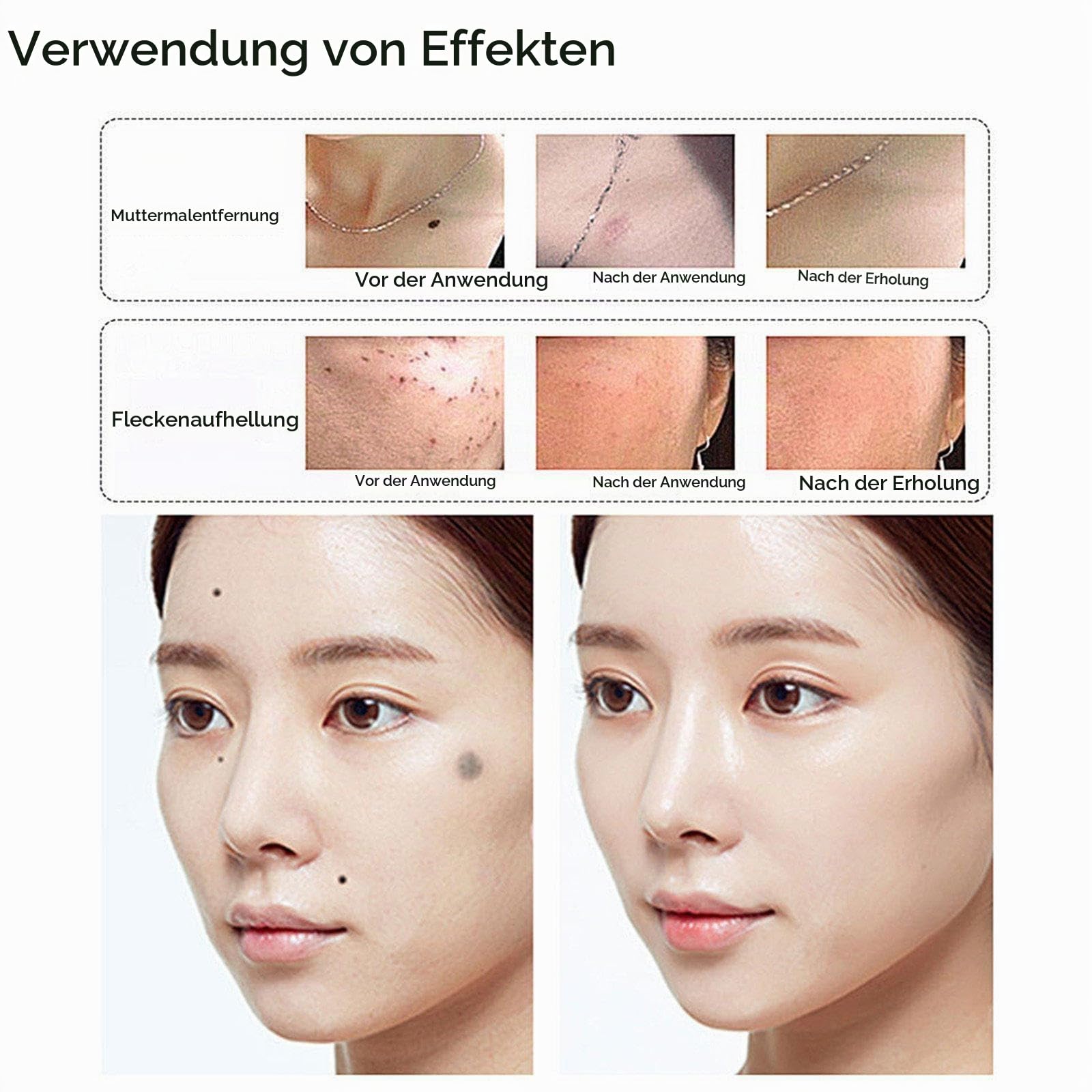 Picosekunden-Stift für zuhause zur Entfernung von Sommersprossen, Muttermalen und Pigmentflecken, LCD-Anzeige, Blaulicht, 9 Modi, aufladbar,Blau