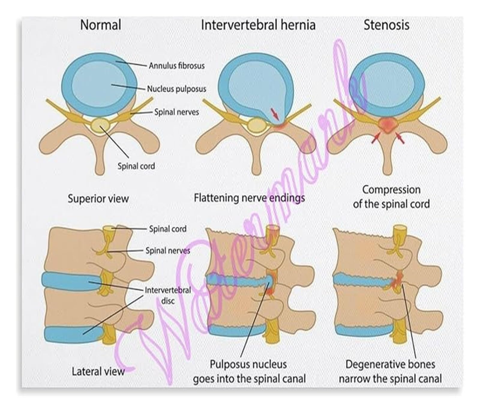 IDGTTLDF Lumbar Spinal Stenosis Poster Cauda Equina Syndrome Warning Signs Health Education Home Clinic Wall Decor Framed,16x24inch(40x60cm)