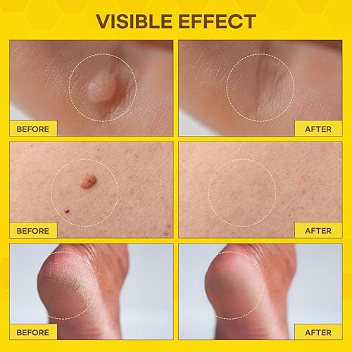 Miniatura 4 de SupreH Eliminador de verrugas de veneno de abeja de acción rápida Congelación de verrugas con ácido salicílico y crema de veneno de abeja -