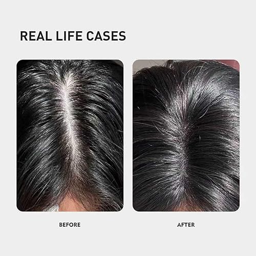 Miniatura 3 de 0.9% KX-826 KINTOR Productos de Crecimiento del Cabello Espuma, Bloqueador DHT para Hombres y Mujeres Regreso del cabello, 6.1 fl oz Pro