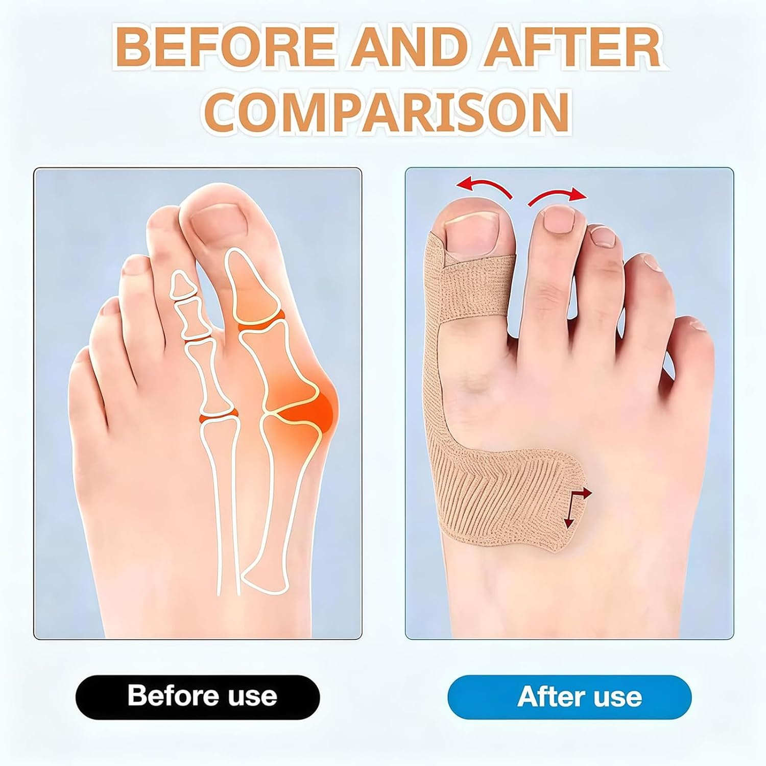 40 Pcs Pre-Cut Bunion Corrector Kinesiology Tape– Elastic, Breathable & Hypoallergenic Latex-Free Toe Support Strips, Self-Adhesive Hallux Valgus Corrector for Men & Women (Skin color, 40 Pcs)