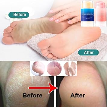 FETNHU Foot Care Cream, Anti Cracked Foot Cream, Moisturizer Stick Foot Balm for Dry Cracked Feet (2PCS Blue)