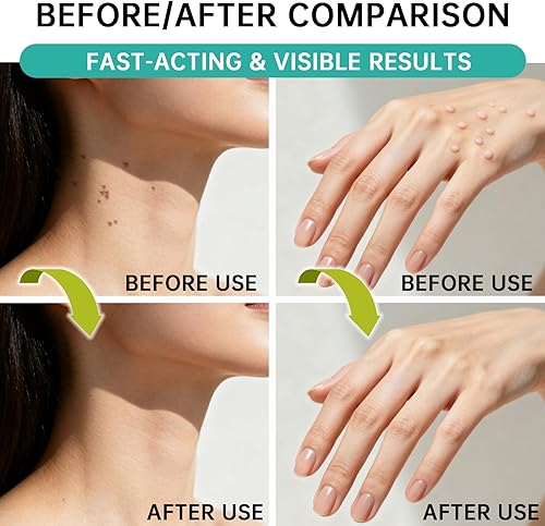 Miniatura 5 de SERYNTH Removedor de verrugas de ácido salicílico, potente fórmula de congelación líquida para eliminar verrugas, rápida y sin dolor para eliminar