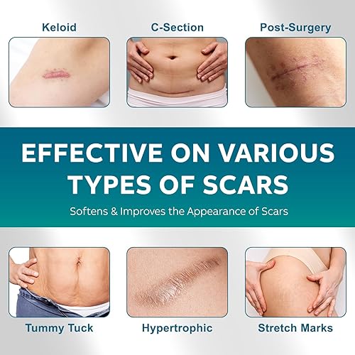 Miniatura 3 de Hojas de silicona para cicatrices, cinta de silicona para cicatrices (rollo de 1.6 x 120 pulgadas, 118.1 in), cinta de silicona para cicatrices