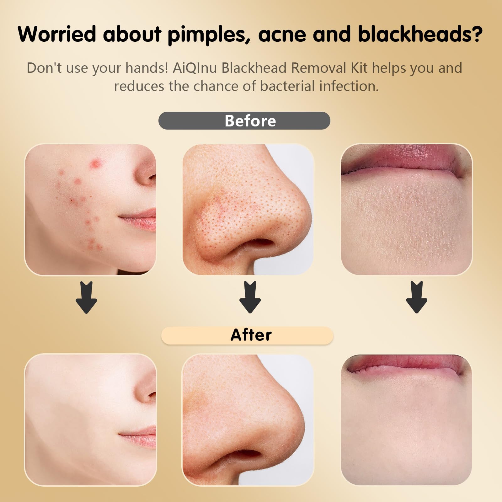AiQInu 10 piezas Puntos Negros Kit, Herramientas para Eliminar Espinillas, Extractor de Acné Kit Blackhead Remover de Acero Inoxidable, Adecuado para Espinillas, Acné y Otras Impurezas de La Piel