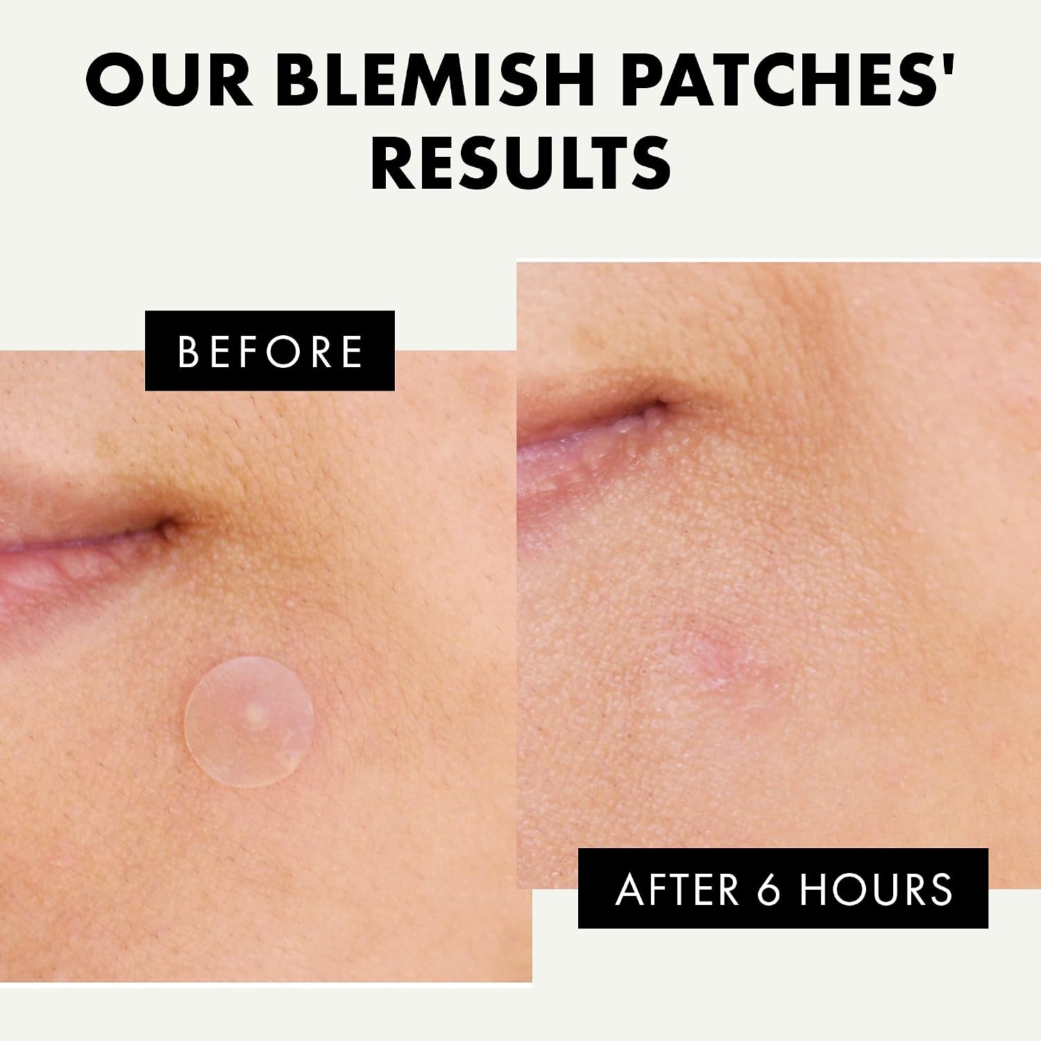 ๐ช๐๐ก๐ก๐๐ฅ ๐ฎ๐ฌ๐ฎ๐ฏ* Pimple Patches for Face, Hydrocolloid Acne Patch, Acne Patches for Face to Cover Zit & Blemish, Invisible Blemish Patches, Suitable for Day & Night, 72 Counts Hydrocolloid Patch