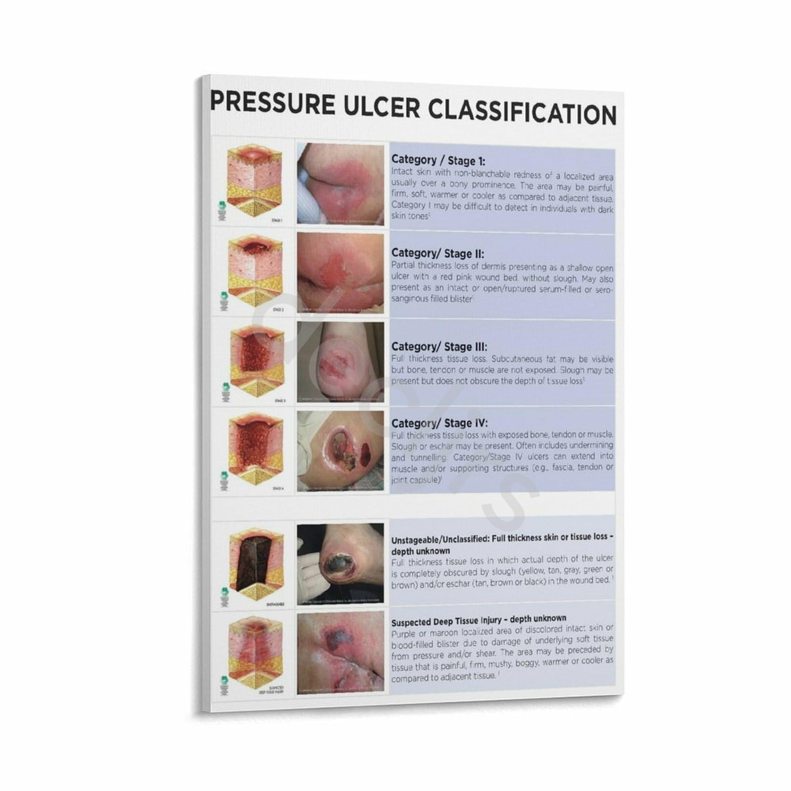 Pressure Ulcer Staging Guide Pressure Management Guide