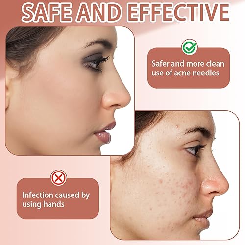 Miniatura 3 de Kit de herramientas para reventar espinillas, herramienta removedor de espinillas, herramienta de acero inoxidable, extractor de comedones, pinzas