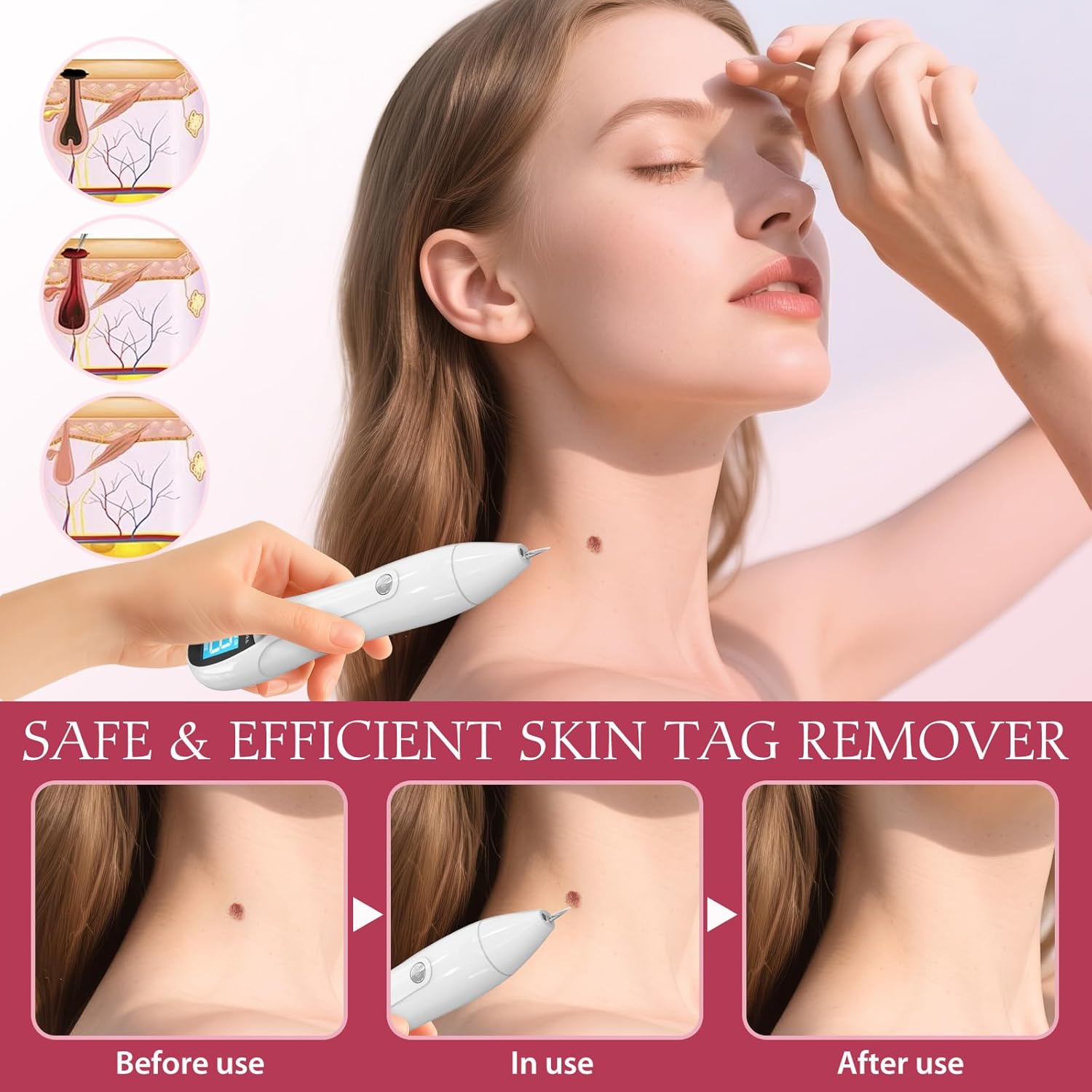SkinTag Remover - CTS-15 Cryo-Freeze Wart & Skin Tag Remover, Safe At-Home Use Device for Common Warts and Skin Tags, Compact and Portable