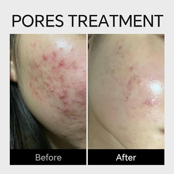 Azelaic Acid Serum Cream 10% Cystic Acne, Rosacea Treatment, Redness Relief, Hormonal Acne, Blemishes, Post-blemish Mark, Pore Refining, Sensitive Friendly Face & Back 1.59Oz