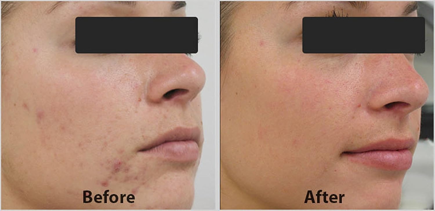 DNA Code®- 20% Glycolic Acid Complex Collagen Rebuild Serum w/Argireline,Matrixyl 3000, CoQ10