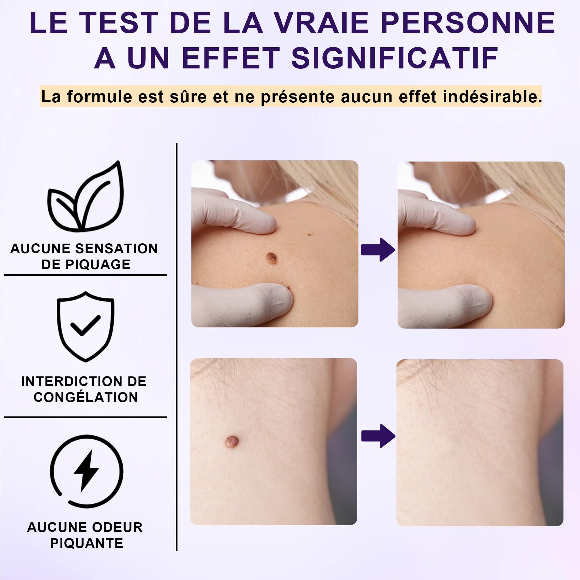 Crema para eliminar verrugas 20g, quita verrugas, verrugas plantares, adecuada para diferentes tipos de piel