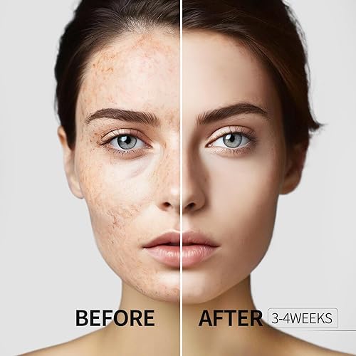 Miniatura 3 de HANYWIL Eliminador de manchas oscuras para cara y cuerpo, suero corrector de manchas oscuras, manchas de la edad, pecas, removedor de manchas