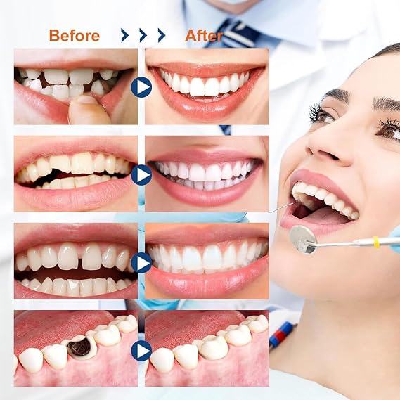 Temporary Tooth Filling Kit,De/ntal Repair Kit for Fixing Broken Tooth & Lost Fillings,False Teeth & Missing Tooth Replacement Kit with Repair Beads#Light Blue