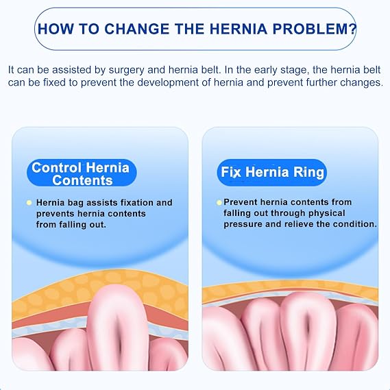 Hernia Belt, Adjustable Hernia Support Truss for Single/Double Inguinal, Groin Straps with 2 Removable Compression Pads, Pain Relief(Medium)