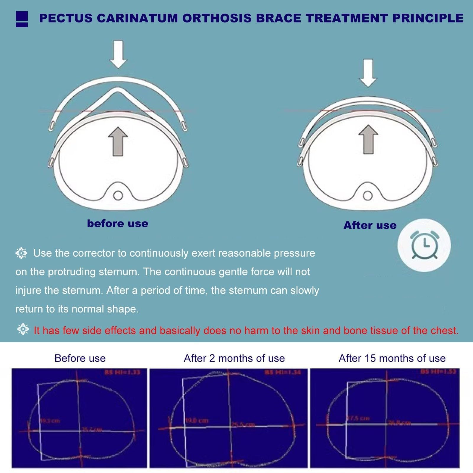 Ortesis para Pectus carinatum: Soporte torácico de Paloma para niños, ortesis para esternón deformado, ortesis para Costillas valgas, tamaño Ajustable, Transpirable(A)